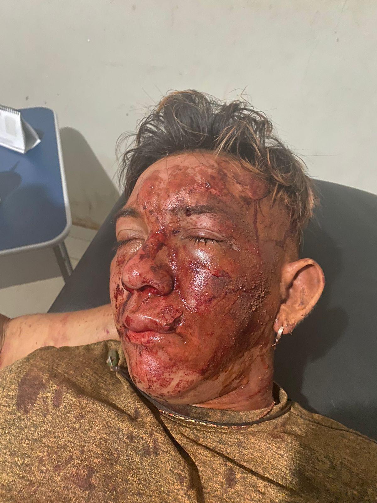 Acidente de moto na Translago