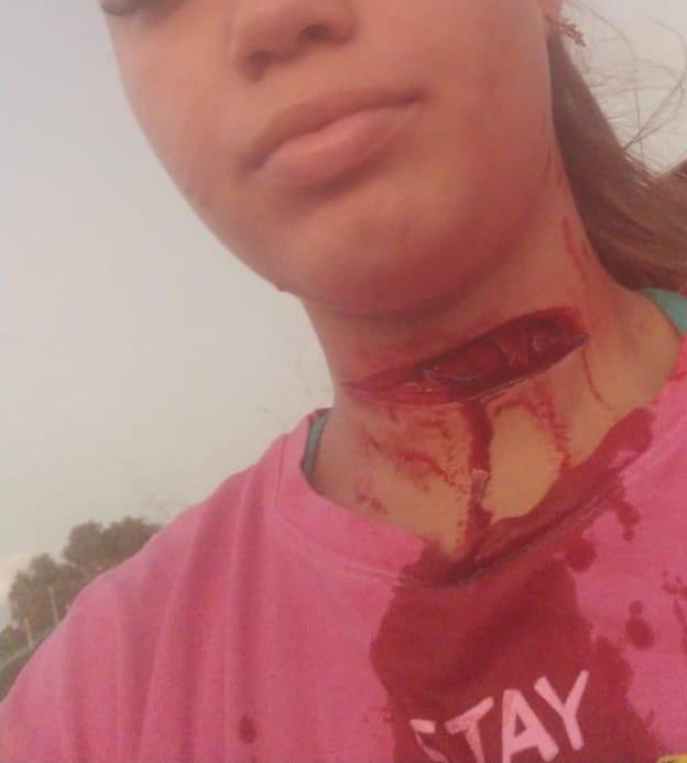 Jovem tem pescoço cortado por linha de papagaio em Rurópolis